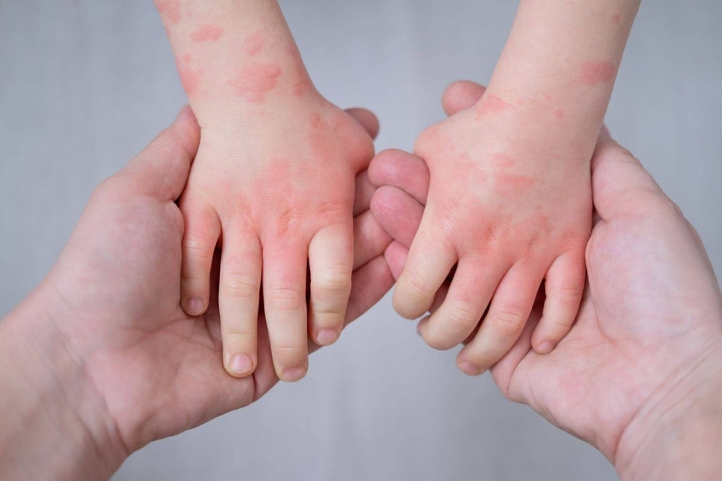 Eczema Relief Soap – Premium Baby Care
